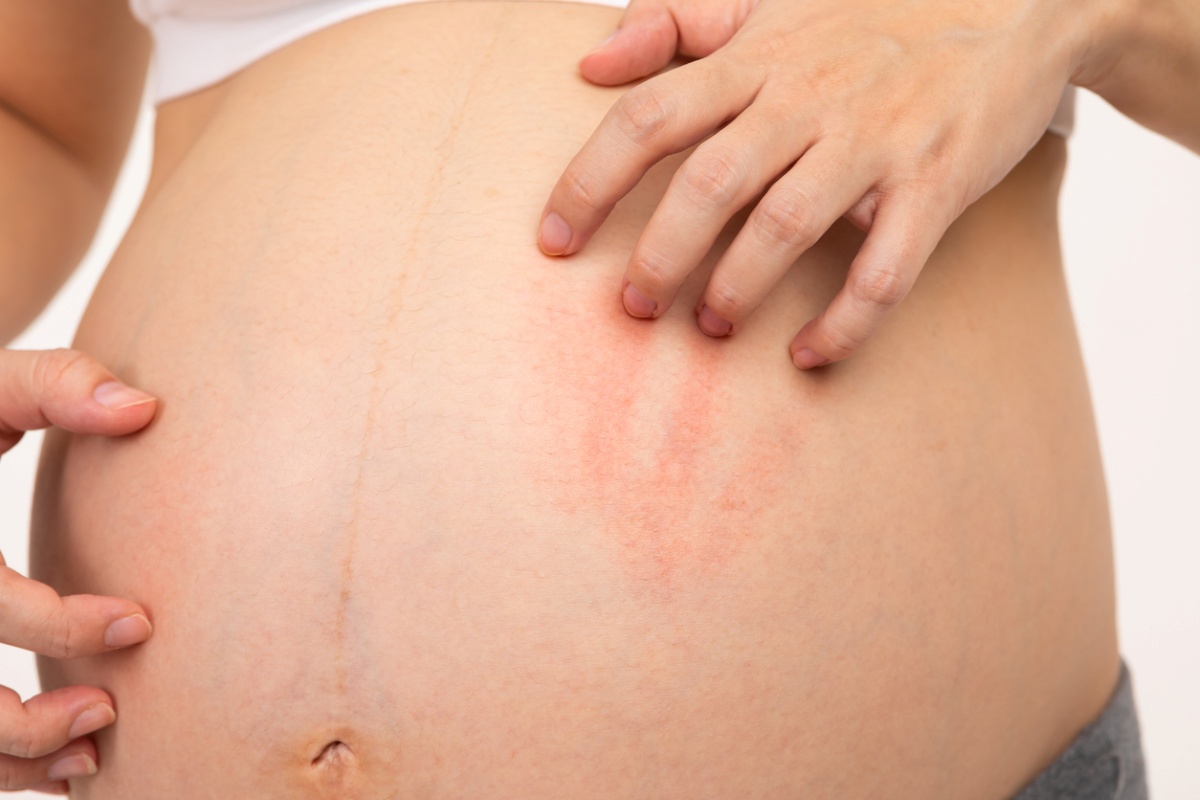 Close-up of a pregnant abdomen with faint red stretch marks and a hand resting on the skin